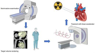 Stereotactic arrhythmia radioablation (STAR) opens a new era in the treatment of arrhythmias?